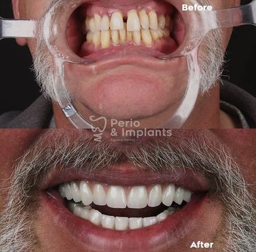 Slider image (6) Perio & Implants Tijuana